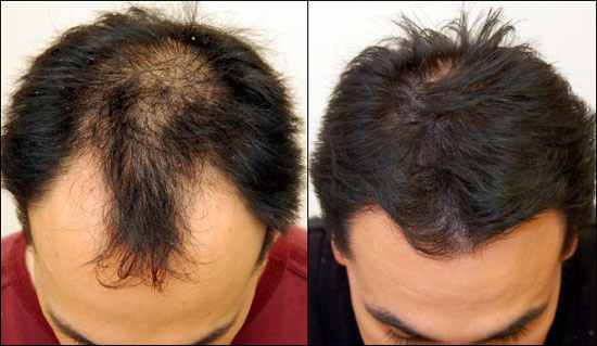 hair-transplant